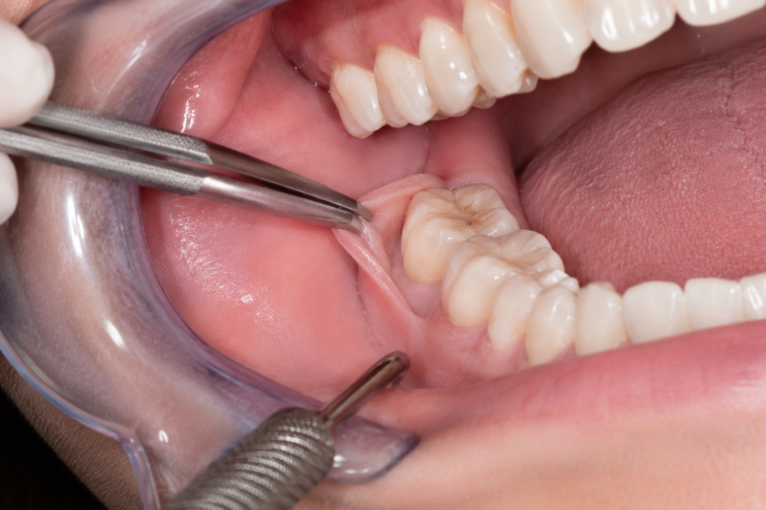 Cirurgia Oral Menor Adequa